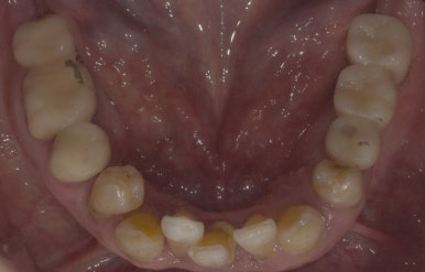 보험임플란트, 임플란트브릿지로 치료한 사례 보여드립니다. 관련 이미지 9