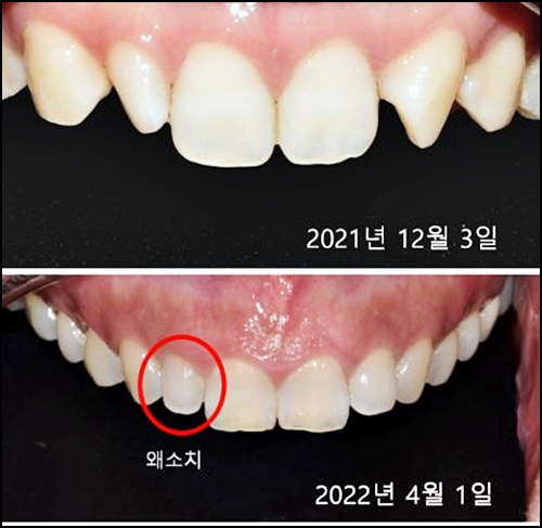 왜소치라미네이트, 치과 의사가 설명해준다면? 관련 이미지 1