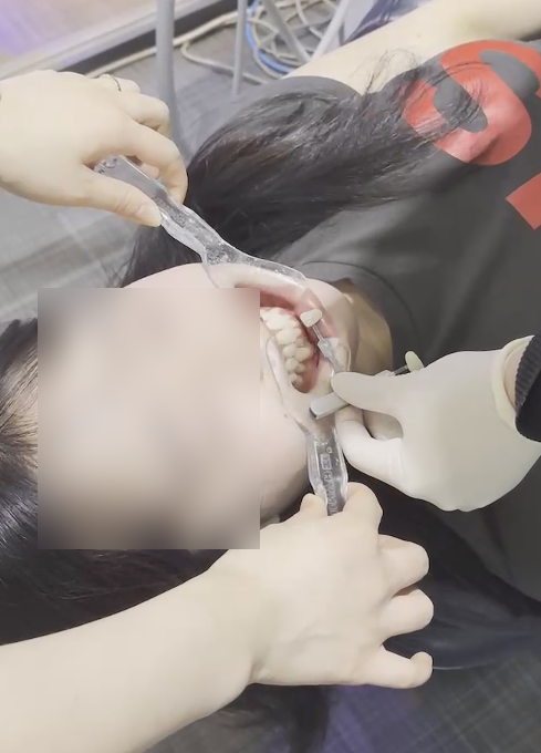 선릉역치아미백후기 보기 전에 관련 이미지 6