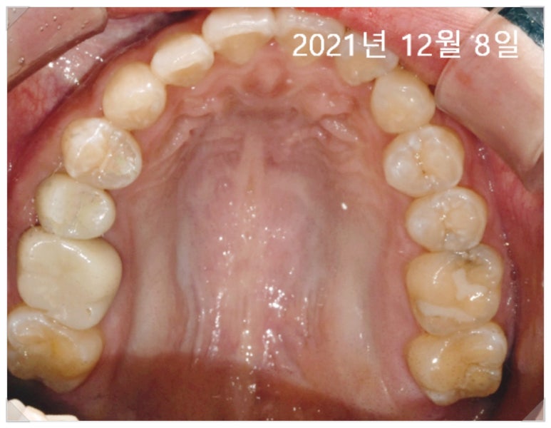 치과 보험 임플란트?전문의가 치료사례 보여드립니다. 관련 이미지 4