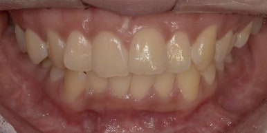 라미네이트 전후사진과 치료비용까지 숨김없이 알려드립니다. 관련 이미지 14