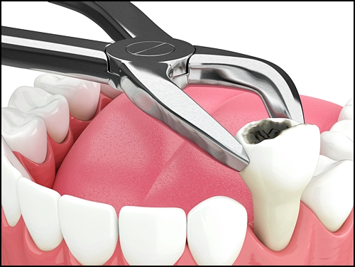 레진 인레이 차이, 치과의사가 알려준다면? 관련 이미지 4