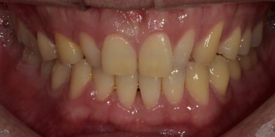 작은치아라미네이트, 치아삭제 없이 가능하다? 관련 이미지 3