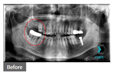 삼성역 임플란트, 이 글만 읽어보셔도 충분합니다. 관련 이미지 3