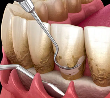 치은박리소파술 필요한 상태? 의사가 알려주는 판단 기준 2가지 관련 이미지 4