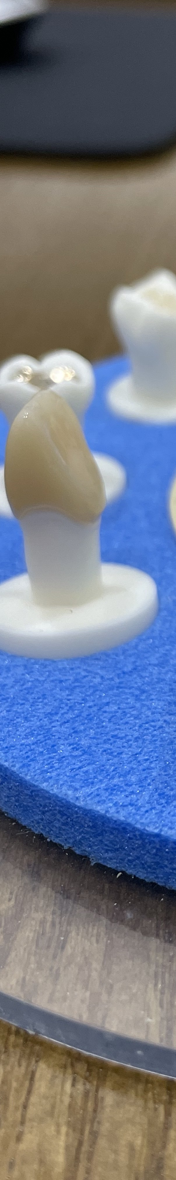 도곡동 충치치료,이에 까만 점이 보인다면? 관련 이미지 6