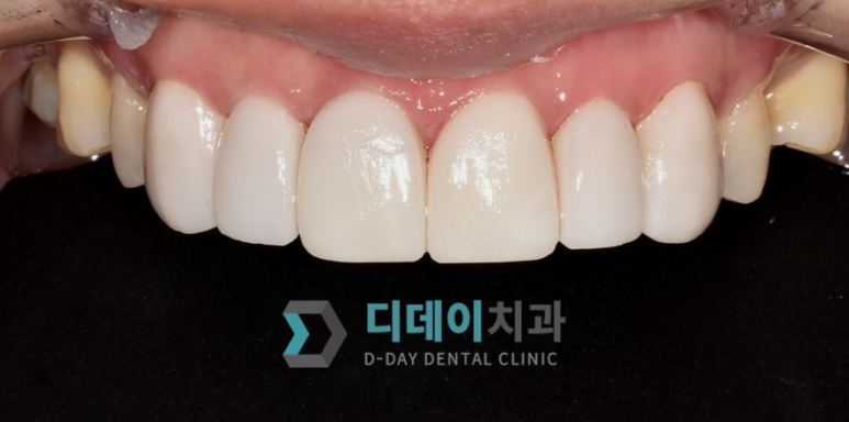 무삭제라미네이트가격? 의미 없는 이유 관련 이미지 2