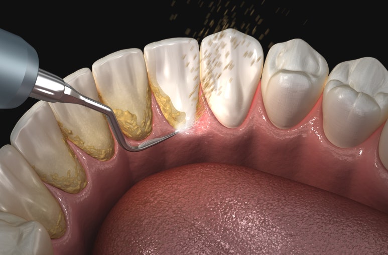 임플란트영구? 내 치아처럼 수명 늘리고 싶다면 필독 관련 이미지 3