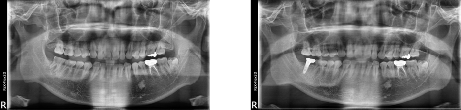 임플란트가격, 적절한 비용은 얼마? 관련 이미지 2