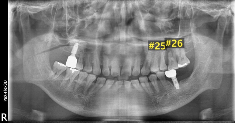 상악동거상술과 뼈이식임플란트 실제 치료사례로 보여드립니다. 관련 이미지 4