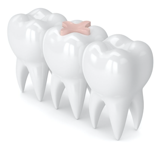 대치동 레진과 인레이 치료 어떤 경우에 사용할까 관련 이미지 3