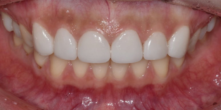 라미네이트 전후 비교, 주의사항, 비용까지 총정리 관련 이미지 6