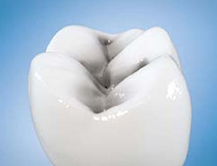 레진인레이차이, 실패하지 않으려면 이 2가지만 확인하세요 관련 이미지 4