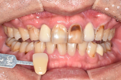 치아미백유지기간부터 종류, 주의사항까지 알려드립니다 관련 이미지 2