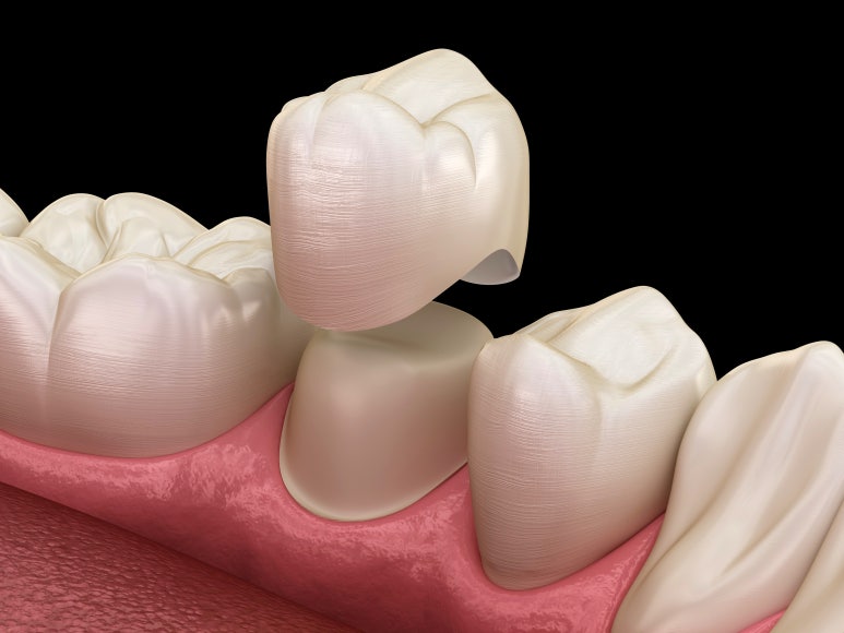 충치치료 기간, 과정, 비용까지 전문의가 알려드립니다. 관련 이미지 13