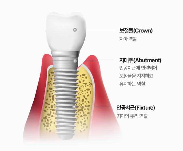 강남구청역치과, 임플란트 저렴한 곳만 찾으시면 안됩니다 관련 이미지 5