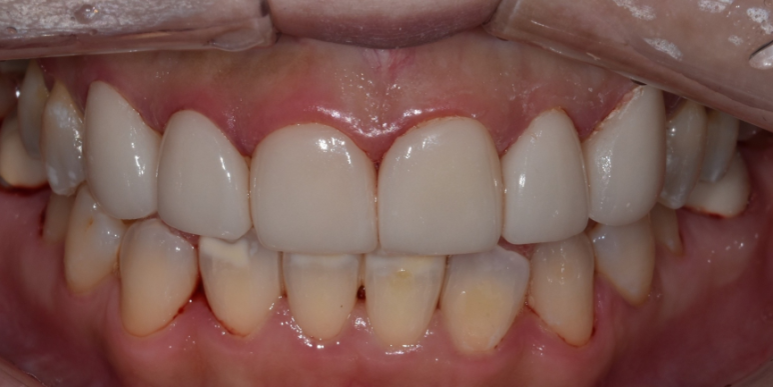 라미네이트 전후 비교, 주의사항, 비용까지 총정리 관련 이미지 12