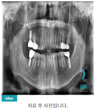 60대 이상 임플란트? 70대에도 할 수 있습니다. 관련 이미지 5