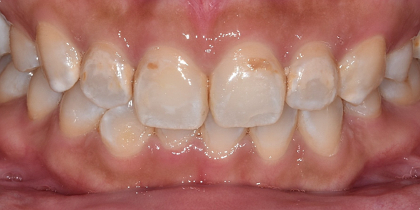 반상치 라미네이트 치료? 얼룩덜룩한 반점이 고민이면 보세요. 관련 이미지 2