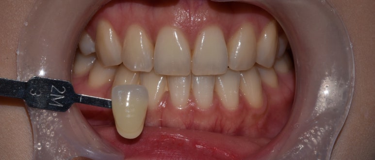 누렁니치아미백, 치료 사례로 보여드리는 개선 효과 관련 이미지 9