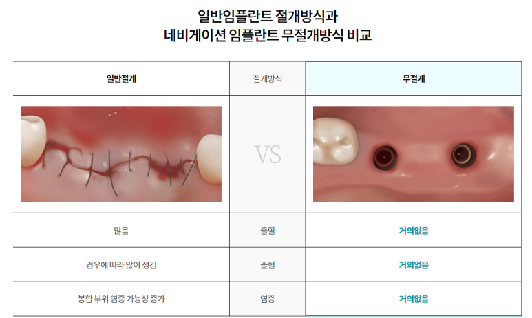 임플란트상악동거상술, 통증은 OO 때문이다? 관련 이미지 13