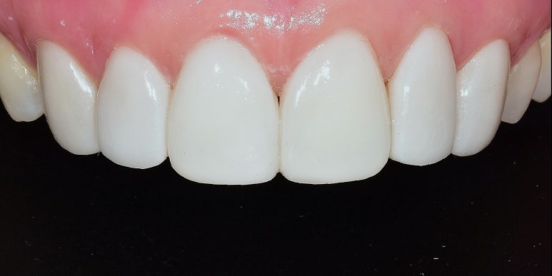 무삭제라미네이트가격, 더 비쌀 필요가 없습니다. 관련 이미지 4