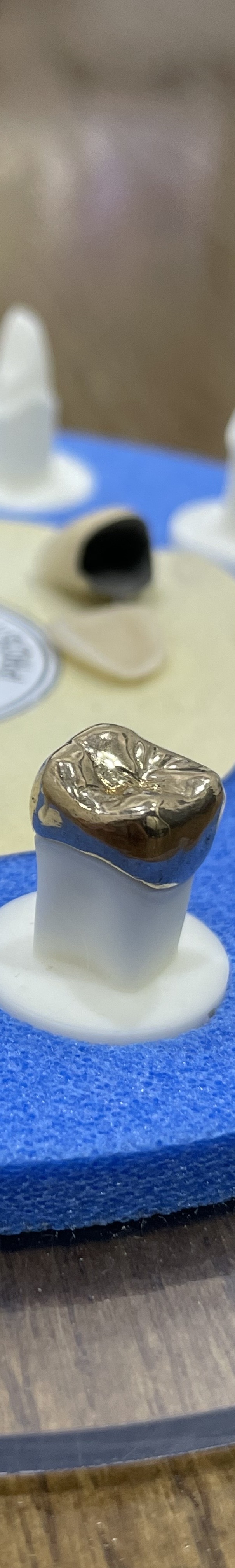 도곡동 충치치료,이에 까만 점이 보인다면? 관련 이미지 9