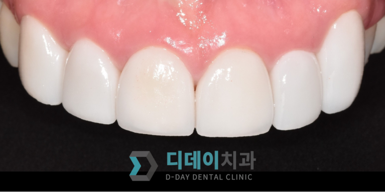 라미네이트후기, 치료사례만 모아 보여드립니다 관련 이미지 16