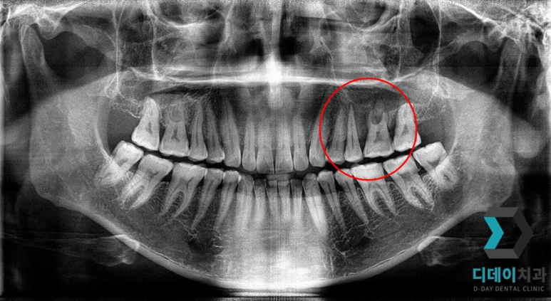 기저질환 환자, 임플란트 가능할까요? 관련 이미지 4