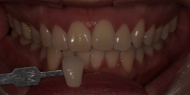 미백치약효과, 진짜 있을까? 치과의사가 전부 설명드립니다. 관련 이미지 6