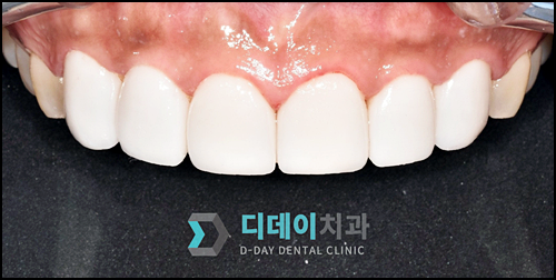 라미네이트재시술? 후회하지 않으려면 확인하세요. 관련 이미지 1