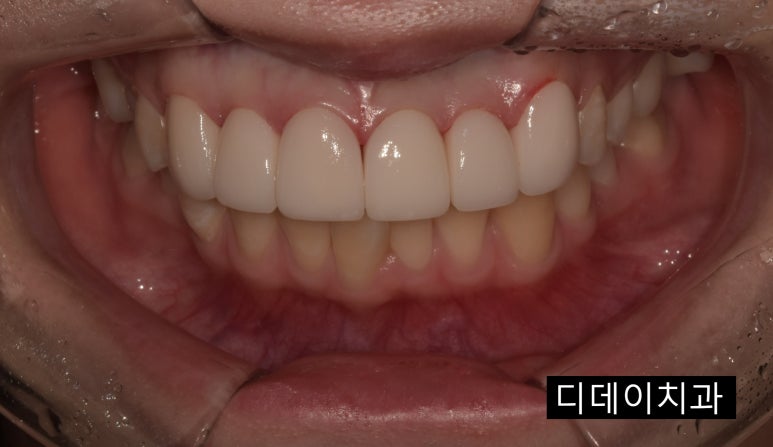 무삭제라미네이트 누구나 다 된다? 속지마세요. 관련 이미지 10