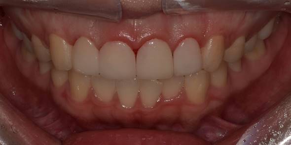 잇몸성형후기, 사례가 없어 고민하셨던 분만 관련 이미지 10