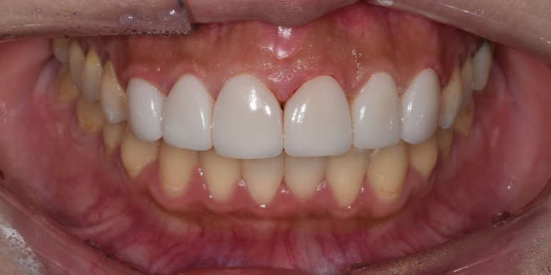 교정후라미네이트? 실제 치료 후기 궁금하신 분만 관련 이미지 5