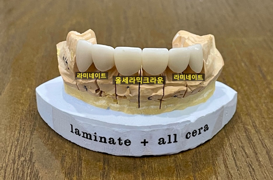 라미네이트올세라믹, 차이점과 치료사례까지 모두 공유합니다. 관련 이미지 4