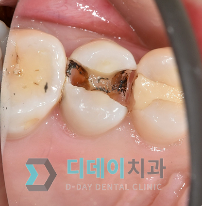 직장인구강검진으로 조기에 충치치료한 사례 공유 관련 이미지 9