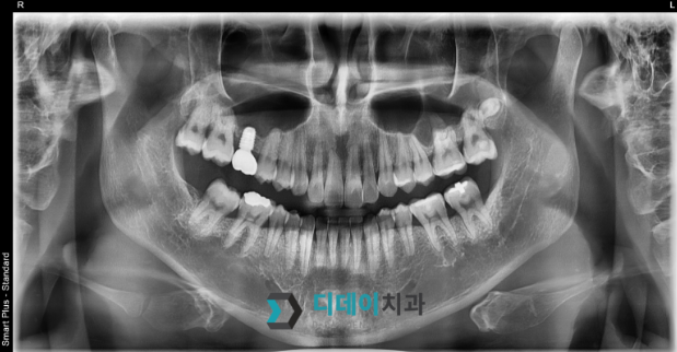 신논현역임플란트, 수술 경험 많은 의사가 알려주는 2가지 기준 관련 이미지 9