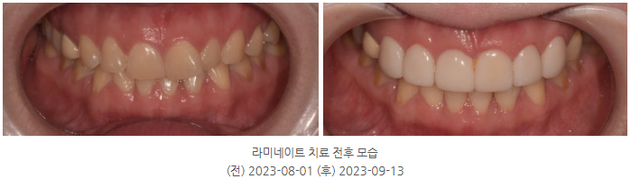 무삭제라미네이트비용, 저렴하다고 선택하면 후회합니다 관련 이미지 4
