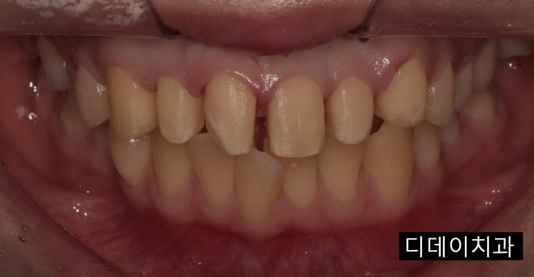 무삭제라미네이트 누구나 다 된다? 속지마세요. 관련 이미지 7