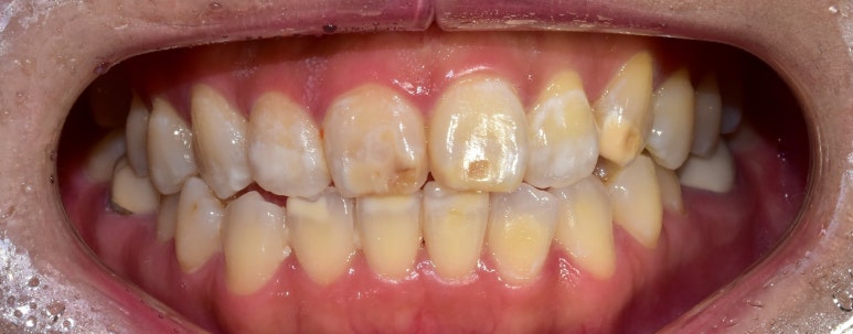 치아반점(반상치, 반점치) 혹시 문제있는건 아닌지 걱정된다면? 관련 이미지 3