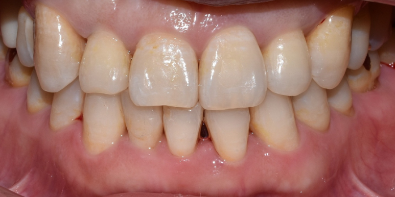 라미네이트 전후 비교, 주의사항, 비용까지 총정리 관련 이미지 7