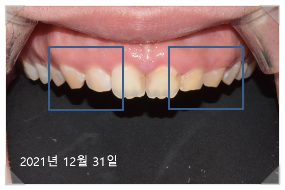 잇몸수술비용? 이 글로 종결합니다. 관련 이미지 5