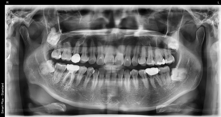 잇몸성형유지기간? 치과의사가 직접 알려드립니다. 관련 이미지 7