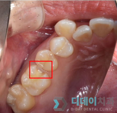 강남충치치료? 티 안나는 "인레이" 치료 사례 관련 이미지 3