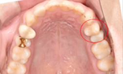 임플란트교체? 걱정되시는분들만 보세요. 관련 이미지 7
