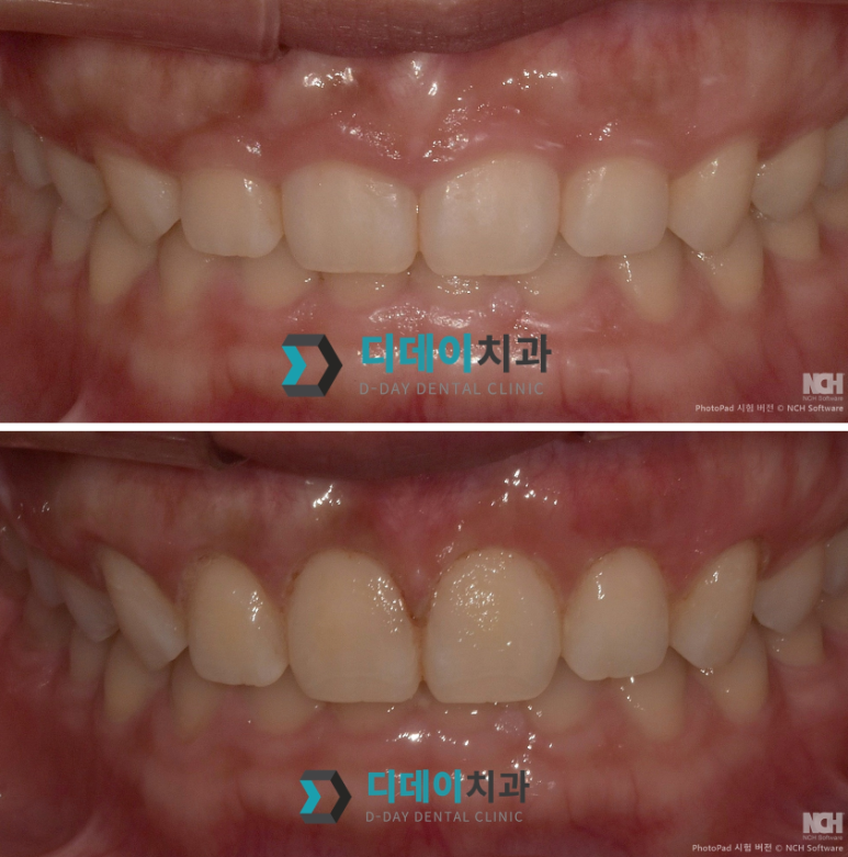 법랑질성형, 잇몸라인이 고민이라면 이 글 먼저 보세요 관련 이미지 5