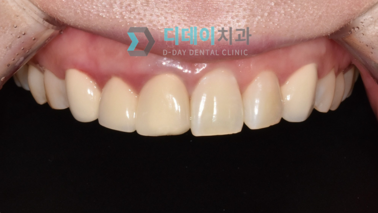 앞니크라운빠짐, 탈락한 경우 재부착 가능할까요? 관련 이미지 2