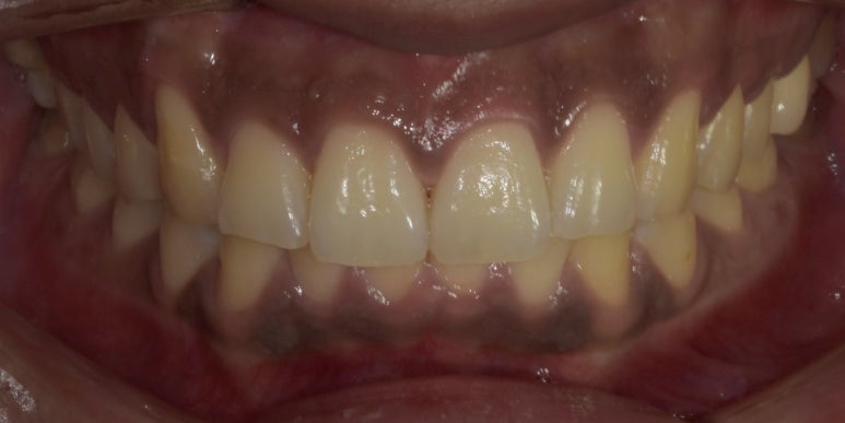 잇몸착색, 변색되어 검은 잇몸 선홍빛으로 되돌리는 방법 관련 이미지 5