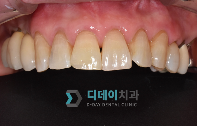 치아성형비용, 비싼 것만은 아닙니다. 관련 이미지 5