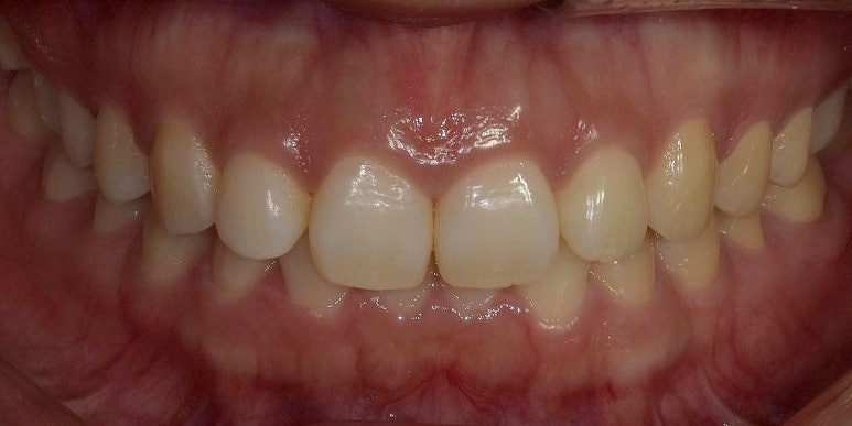 잇몸성형, OO해서 후회해요&hellip; 후회하는 이유는? 관련 이미지 11